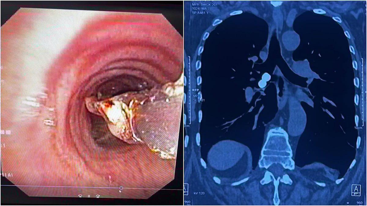 Mumbai News: 78-Year-Old Man Survives After Dental Cap Slips Into Windpipe; Chembur Doctors Remove Object From Lung In 10-Minute Bronchoscopy