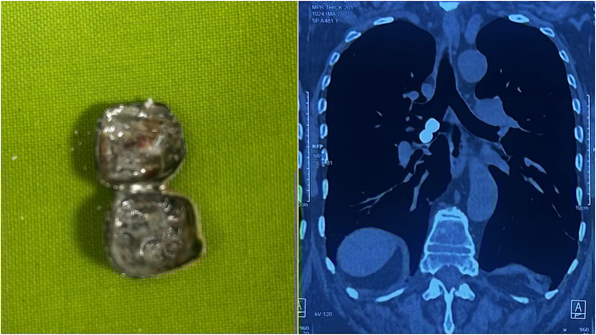Doctors at Zen Multispeciality Hospital, Chembur, successfully removed a dental cap lodged in a patient’s lung through a minimally invasive bronchoscopy