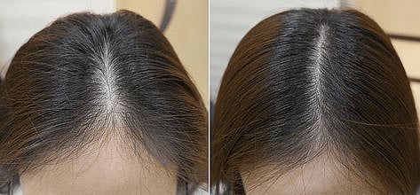 Hair Growth