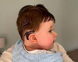 MP News: Cochlear Implant Upgradation Missing In State; Kerala, TN, Rajasthan Fund For Maintenance