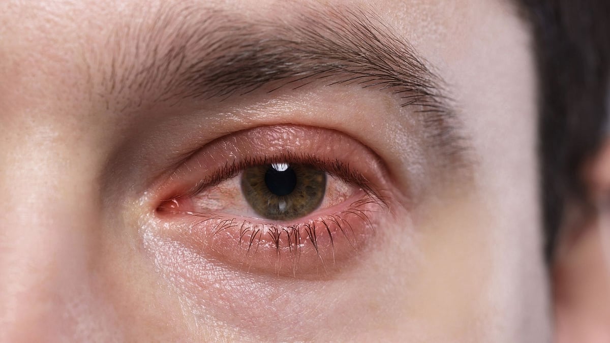 Delhiites Complain Of Eye Irritation Due To High AQI: 5 Must-Follow Tips To Keep Your Eyes Safe 