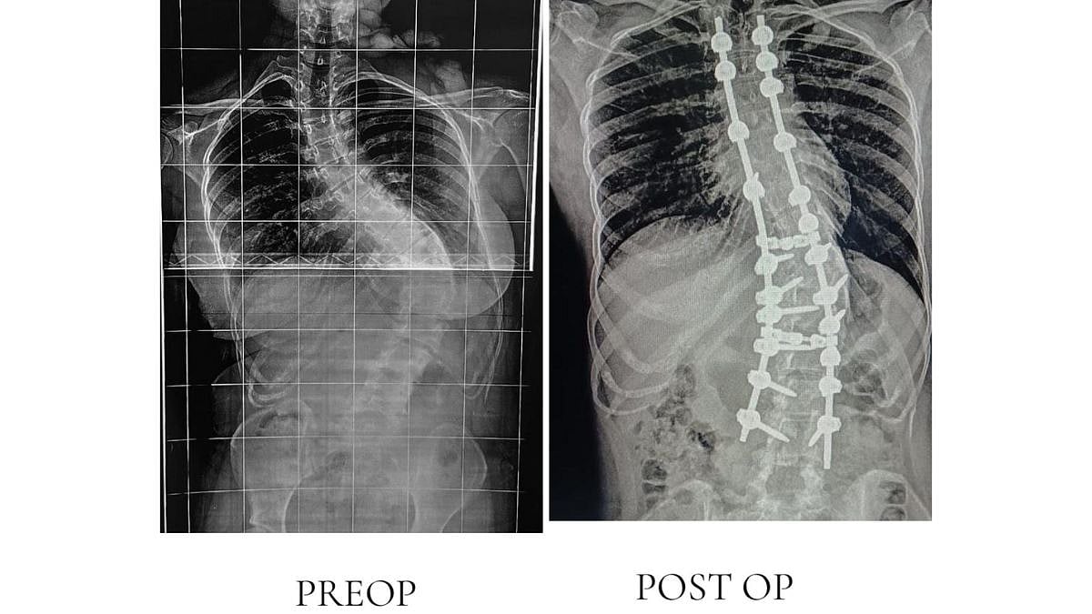 Medical Milestone: Mumbai’s JJ Hospital Becomes First In Maharashtra To Perform Robotic Scoliosis...
