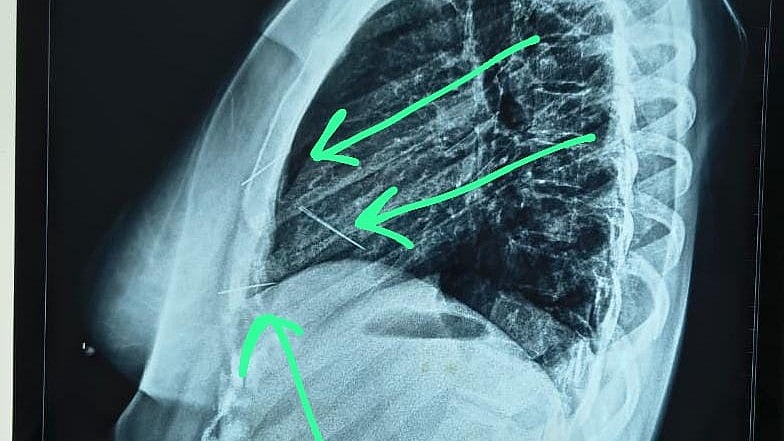 Indore News: Woman With Three Needles In Body Saved At Shri Aurobindo Institute of Medical Sciences