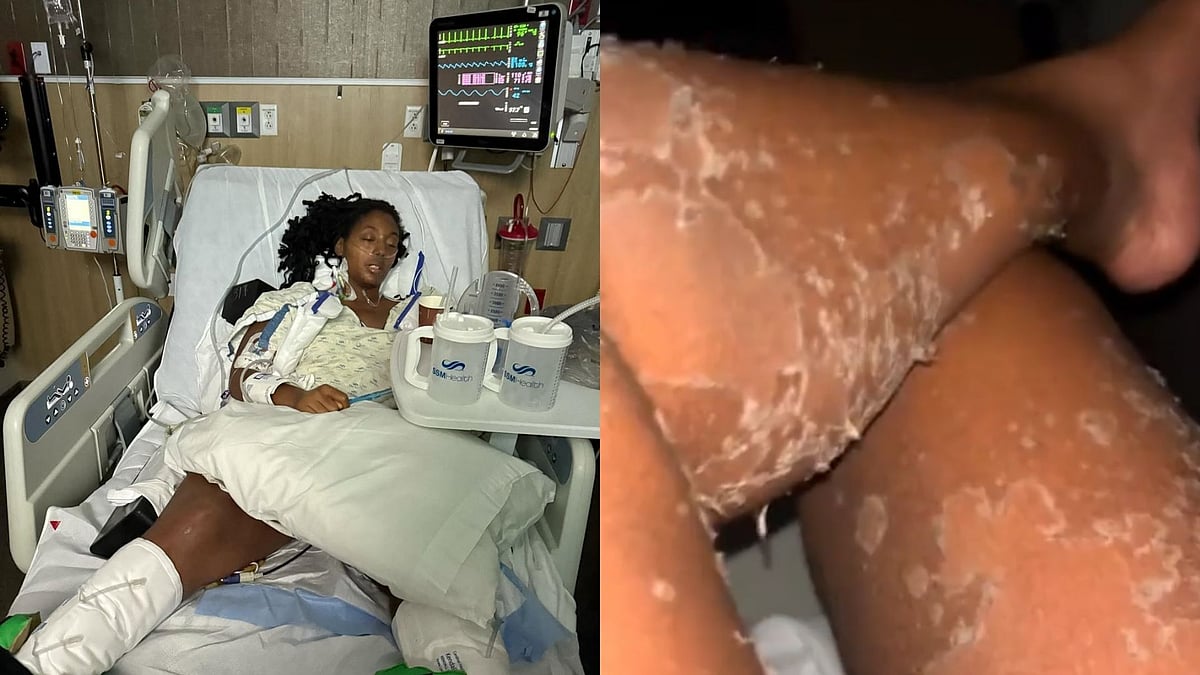 Woman Shares Scary Encounter With Venomous Spider Bite That Had Her Entire Body 'Shedding Like A...
