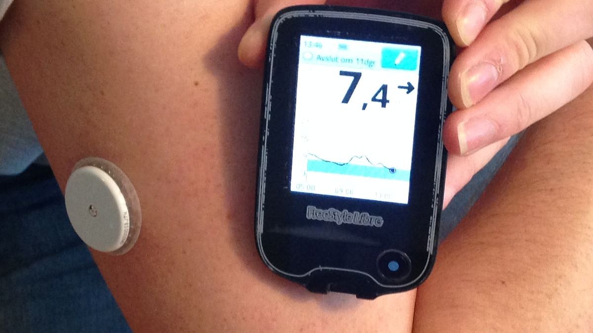 Doctors caution diabetic patients on safe use of continuous glucose monitoring devices following an FDA alert on faulty sensors | Wikipedia (Representational Image)