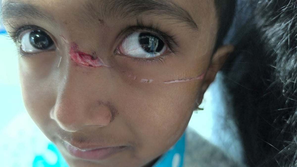 Chhatrapati Sambhajinagar: 5-Year-Old Girl Suffers Facial Injuries After Nylon Manja Entangles Her...