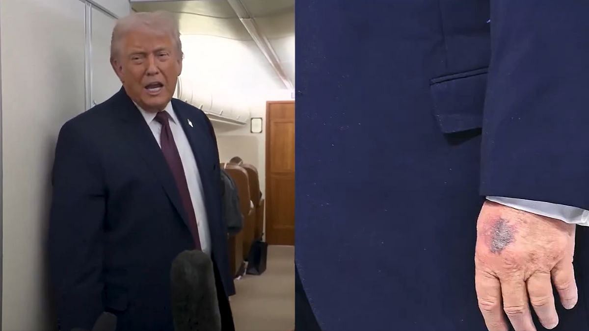 Donald Trump's Bruised Hand Catches Everyone's Eye At Davos Summit, Viral Photos Raise Health...