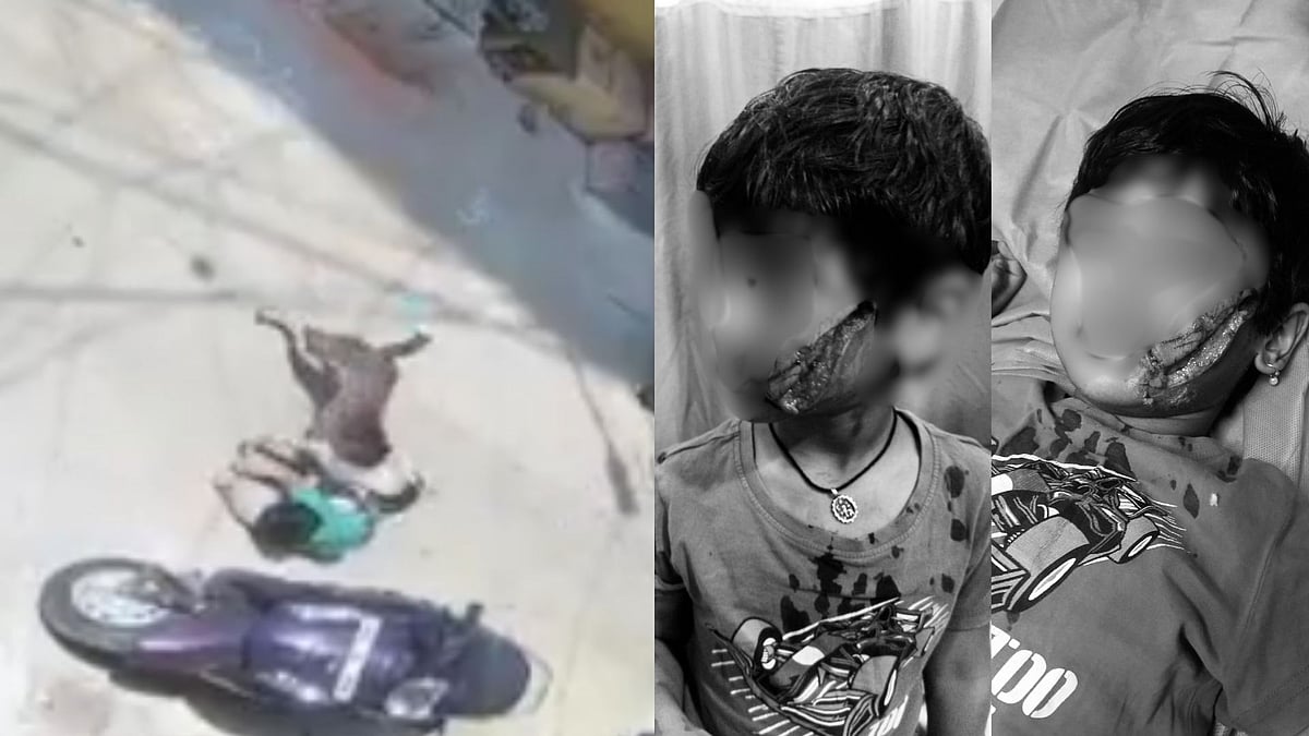 VIDEO: Stray Dog Mauls 5-Year-Old Girl In Hyderabad
