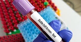 Nashik’s ‘Arunodaya’ Sickle Cell Campaign Gets Big Response; Over 2 Lakh Screened For Sickle...