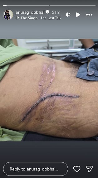 UK07 Rider shares picture of scar