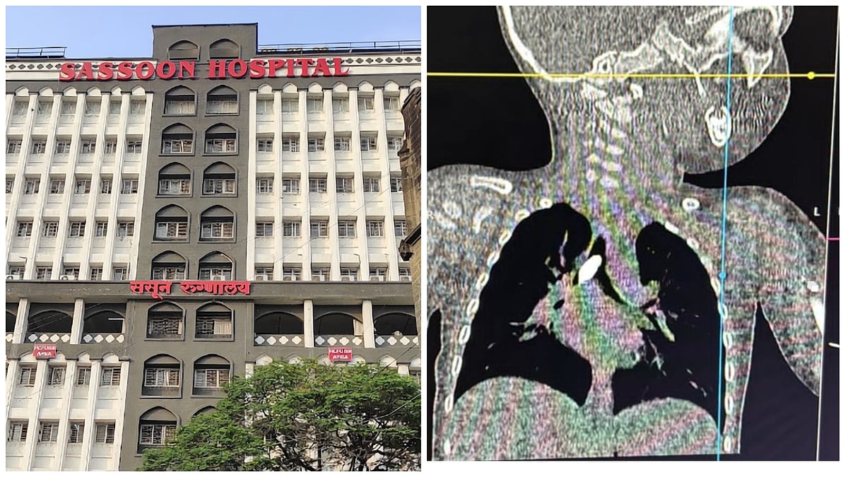 Pune: Sassoon Doctors Perform Emergency Surgery To Save A One-Year-Old With Airway Blockage | Sourced