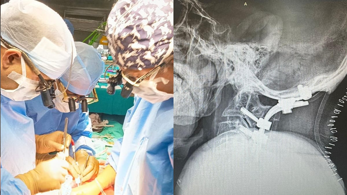 Mumbai: Man Walks Again After Rare Spine Surgery Ends 30 Years Of Pain And Disability