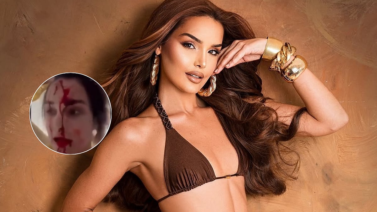 Model Andrea Del Val Attacked By Her Stylist In Cannes Hotel, Shares Disturbing Video With Blood-Soaked Face