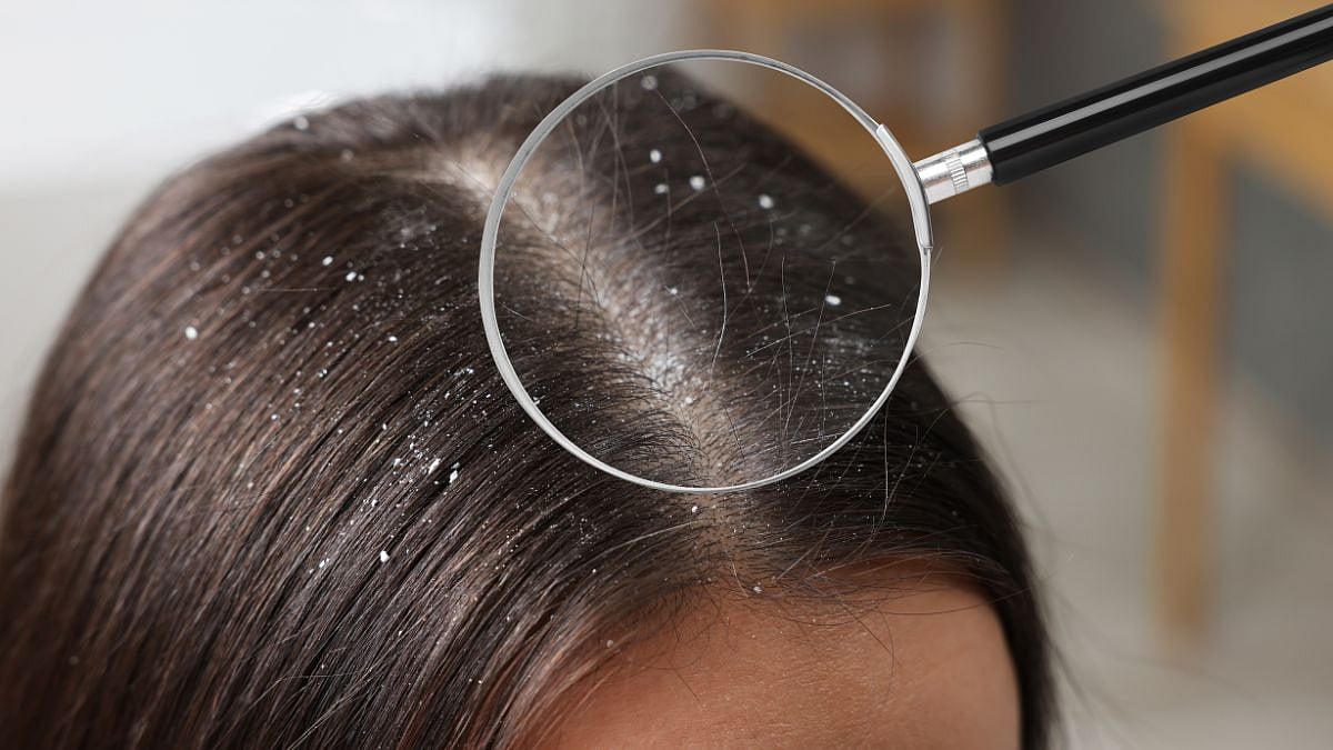 Say Goodbye To Dandruff: Ayurvedic Remedies For A Healthy Scalp
