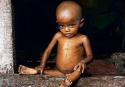 Complementary Feeding Day: Today, One-In-Three Malnutrition Crisis Puts Focus On Complementary Feeding
