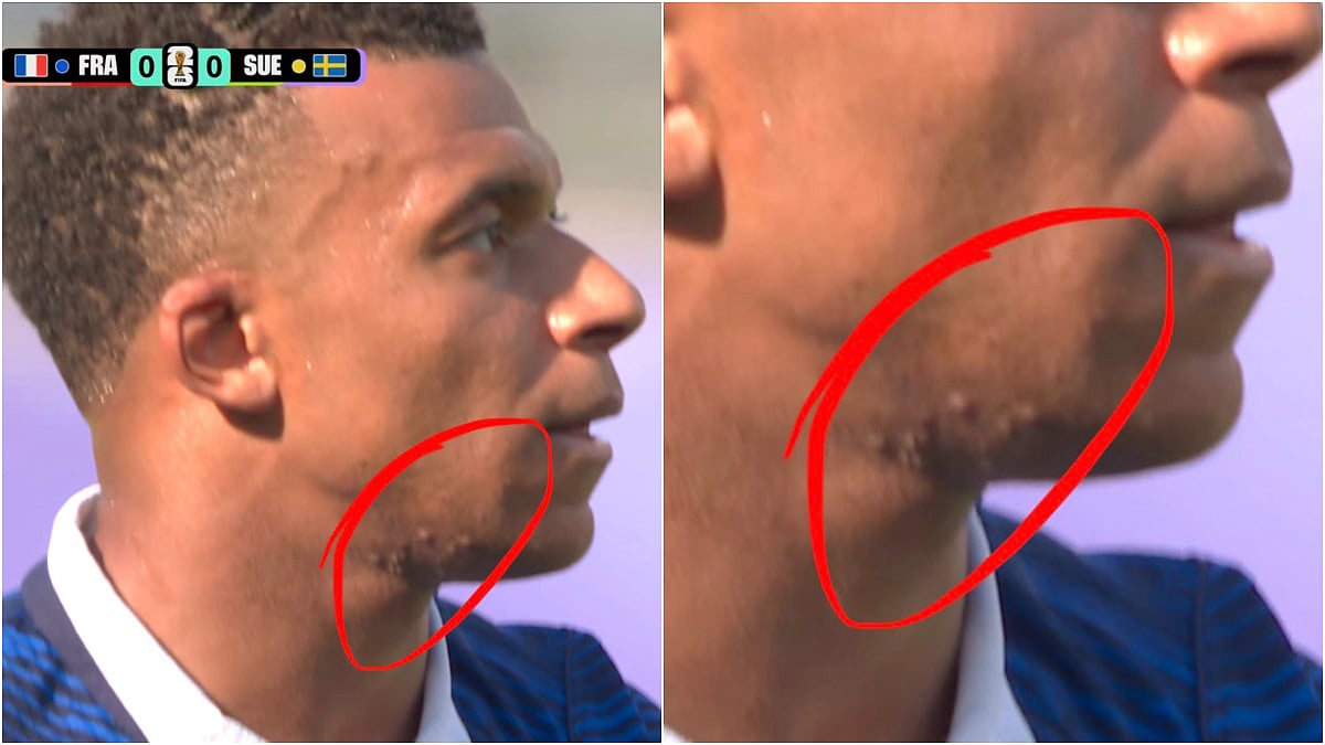 Kylian Mbappe's Face Marks Go Viral During FIFA World Cup 2026, Spark 'Voodoo' Buzz On Social Media