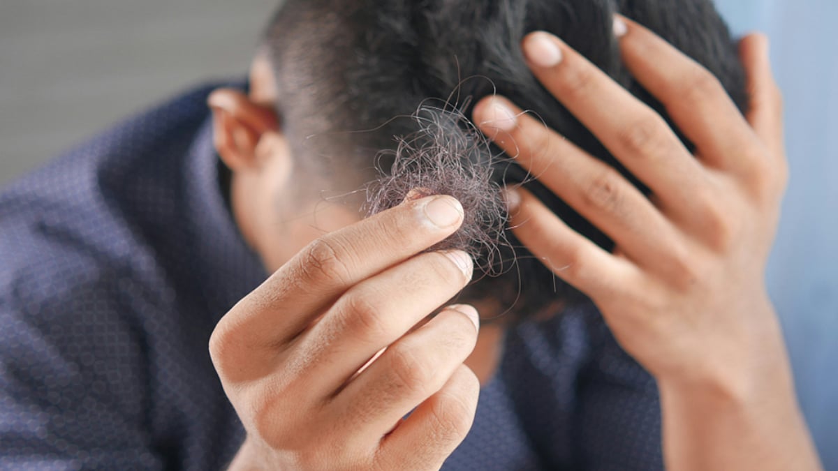 Receding Hairline: Causes And Treatment Options
