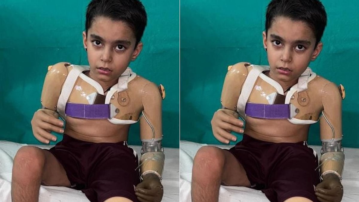 Burhanpur Boy Walks Again With Robotic Limbs After Surviving High-Voltage Shock