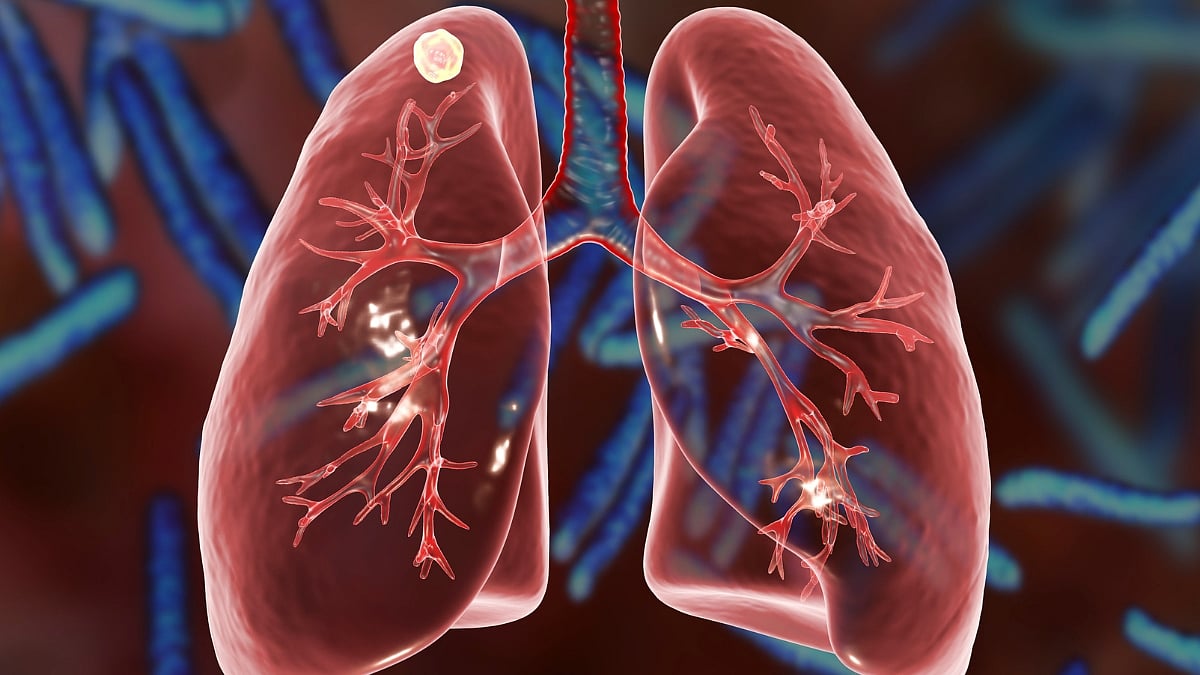 Mumbai: 10-Year-Old Girl Misdiagnosed With TB, Asthma For 7 Years; Doctors Find Pen Cap Lodged In Lung, Remove Part Of Organ
