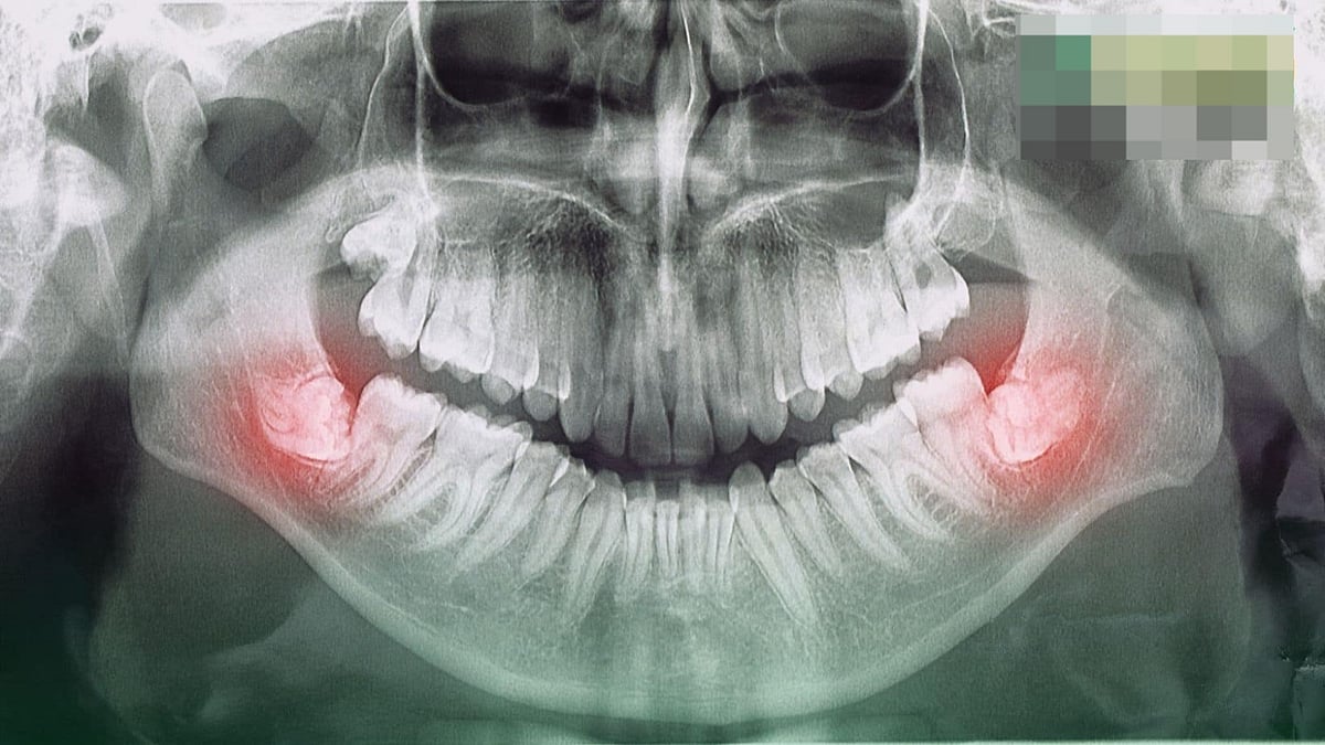 AIIMS Bhopal Develops Indigenous Device To Make Wisdom Tooth Removal Easier, Reduce Pain & Swelling