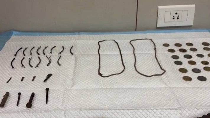 Doctors Remove 23 Coins, Nail Cutter & Other Objects From Teen's Stomach In Tamil Nadu