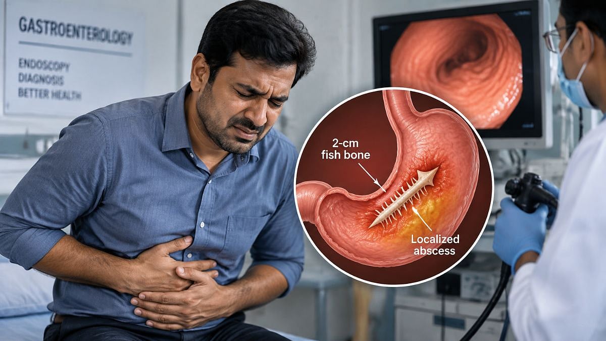 Navi Mumbai: Doctors Remove 2-cm Fish Bone Embedded In Stomach Wall, Help Patient Avoid Open Surgery