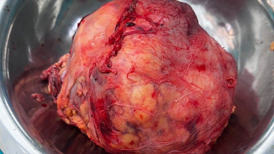 8-Hour Surgery Removes 2.5 Kg Kidney Tumour In Indore
