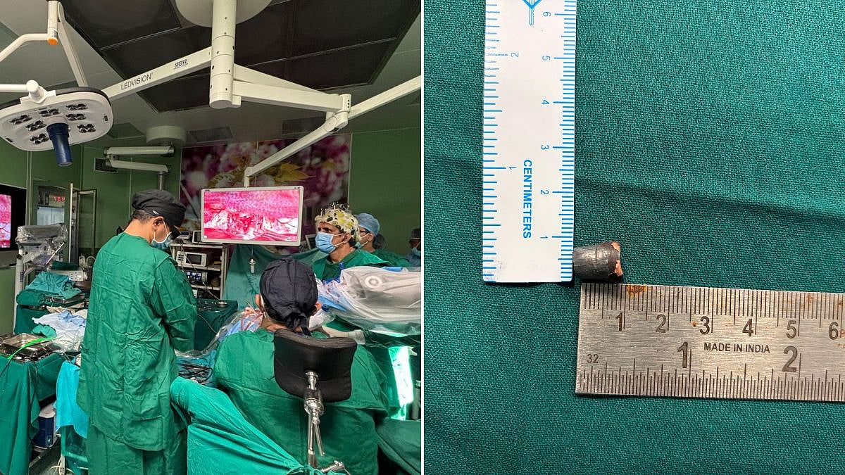 Mumbai Medical Breakthrough: JJ Hospital Doctors Remove 1-Cm Bullet Lodged Near Brain's Major Blood Vessel Using Advanced Techniques