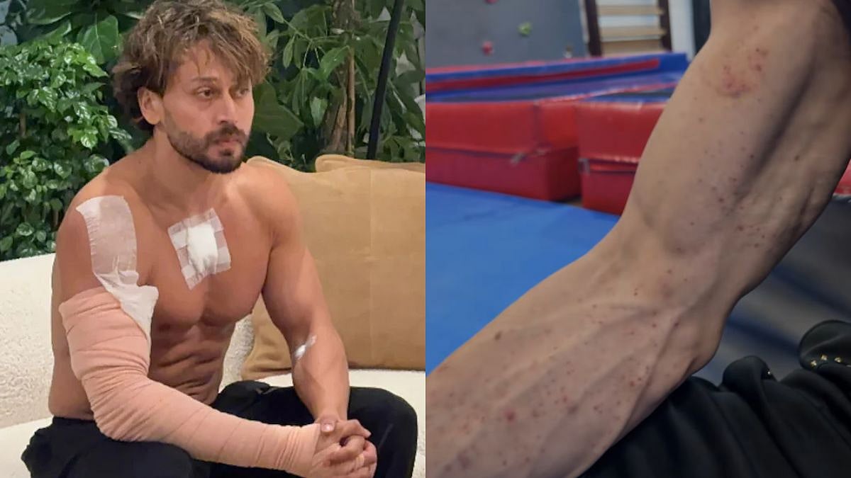 Tiger Shroff's Team Shares Video Of Red Spots On Injured Arms Days After Firing Incident, Posts 'God Is Kind'