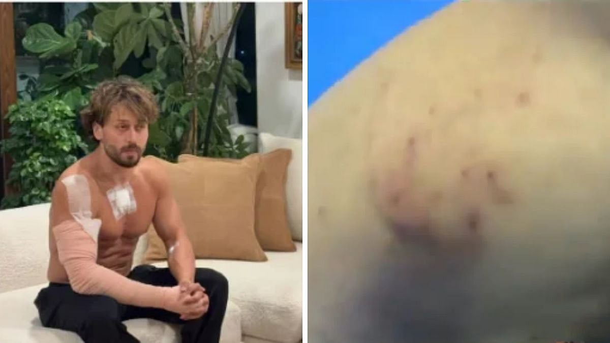 Tiger Shroff's Team Shares Video Showing Bruises, Pellet Marks After Firing Incident