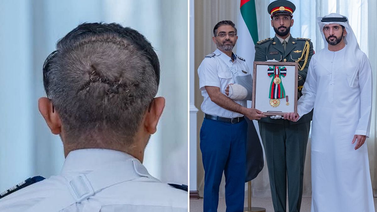 '174 Thanks Signatures’: Captain Smit Machchhar’s Head Stitches Emerge, Social Media Hails Flydubai Pilot For Saving Lives