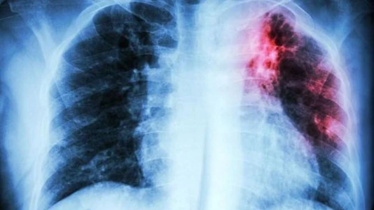 Indian Patent Office Rejects TB Drug Patent, Boosting Push For Affordable MDR-TB Treatment