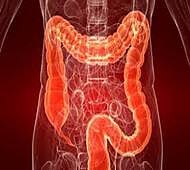 3D hydrogel biochips to detect bowel cancer early
