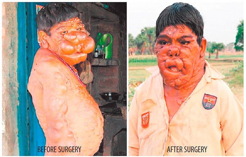 City docs give new lease of life to ‘bubble wrap boy’ from Bihar