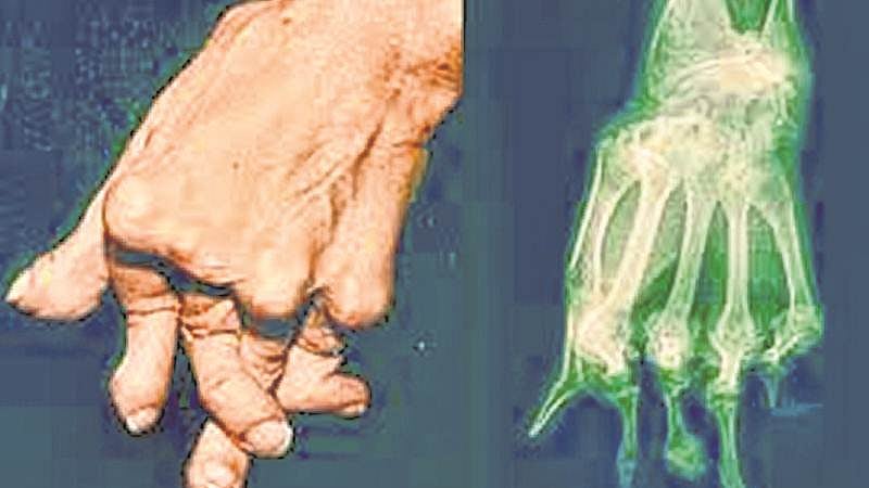 Mumbai: Rheumatoid arthritis affects women three times more compared to men