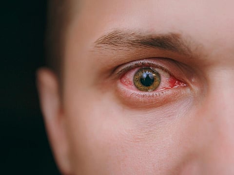 The study showed that when used on wounded corneas in animal models, human breast milk led to an increase in re-epithelialiation - a part of the wound healing process.