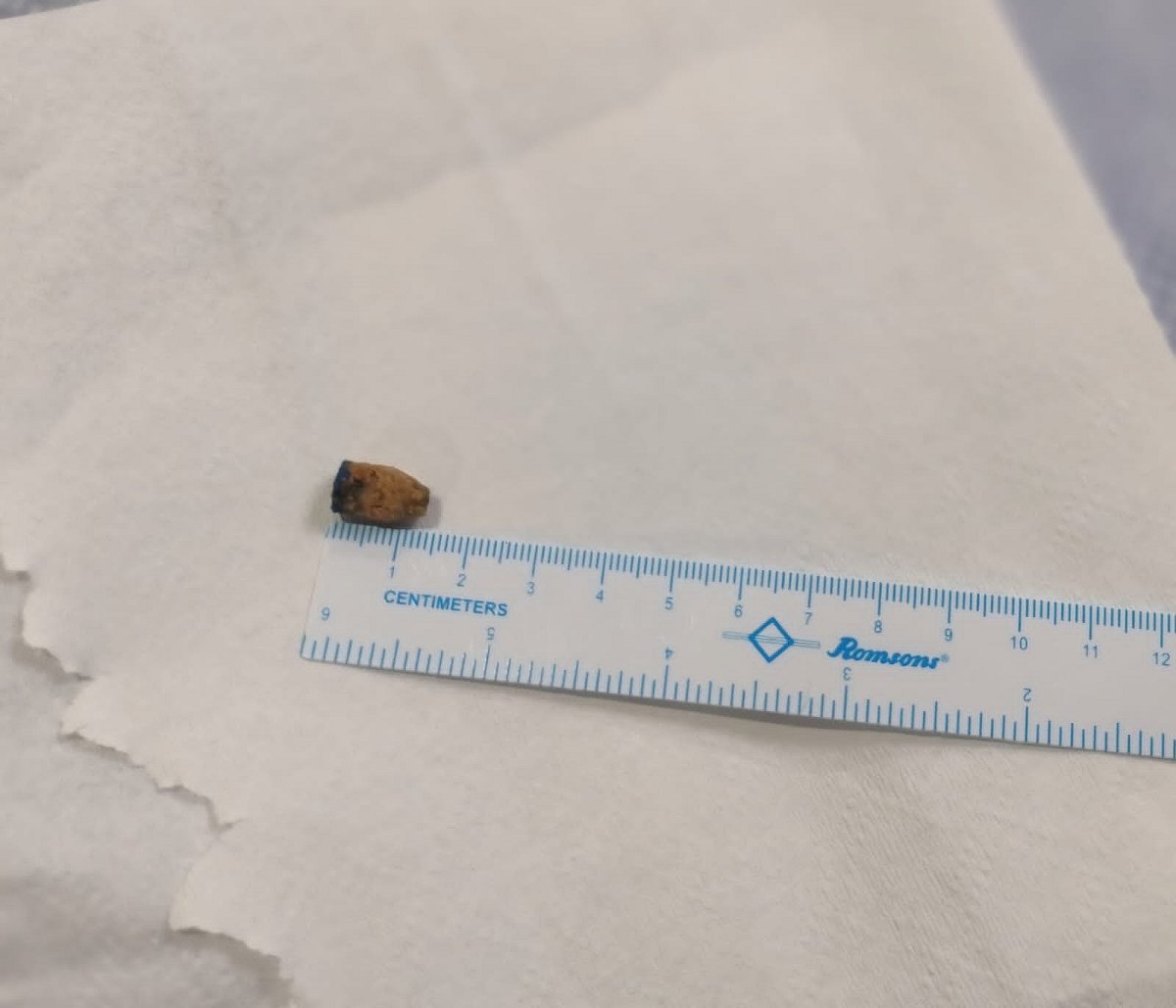 If a child accidentally swallows any object, immediate medical attention is necessary to prevent severe complications.