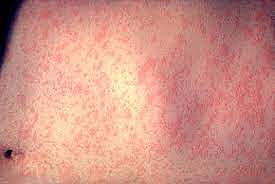 As of March 28, 2025, the CDC reported 483 confirmed measles cases across 20 states.