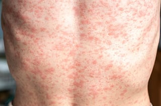US reports fifth death due to measles. Outbreak in Pennsylvania has affected 943 patients in 29 counties, state officials said. Picture for illustrative purposes only.
