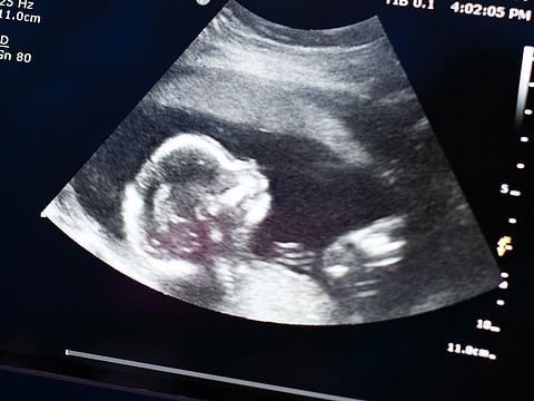 Greek woman has IVF birth from 22-year-old embryo after losing son