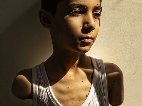 Mahmoud lost both arms above the elbow after he was hit by a missile fired by Israeli planes during the war on Gaza.