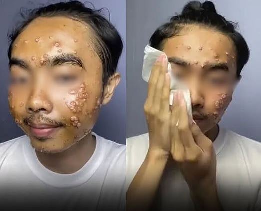In a viral video, he explains how molluscum contagiosum caused raised bumps on his skin.