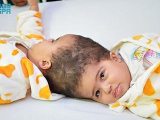 Eritrean twins separated after 15-hour surgery at Saudi children’s hospital