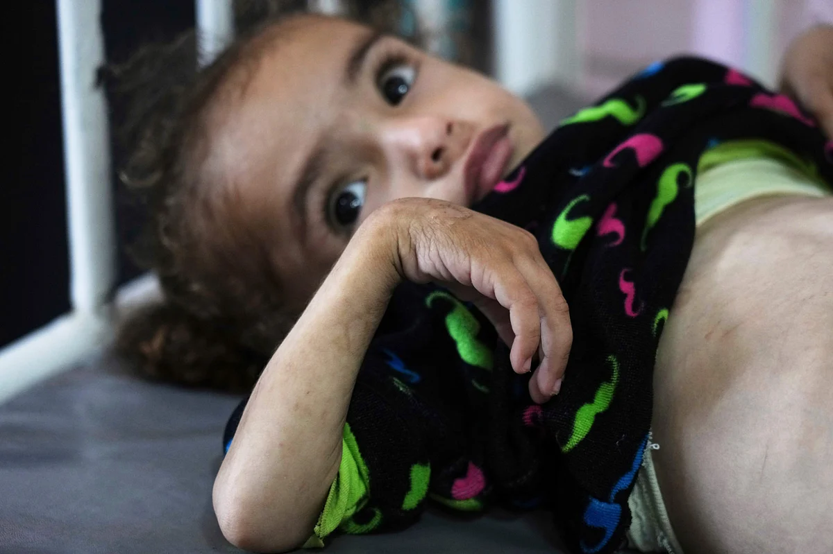 Mayar Al Arja, 2, who suffers from malnutrition, lies on a bed in a clinic in Nasser hospital, Khan Younis, Gaza, Wednesday, May 21, 2025.  