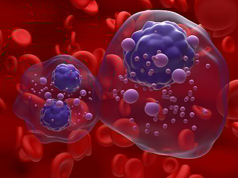 How early detection and innovative therapies improve outcomes for multiple myeloma 