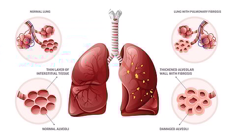 How many trials does it take to change the story for pulmonary fibrosis?