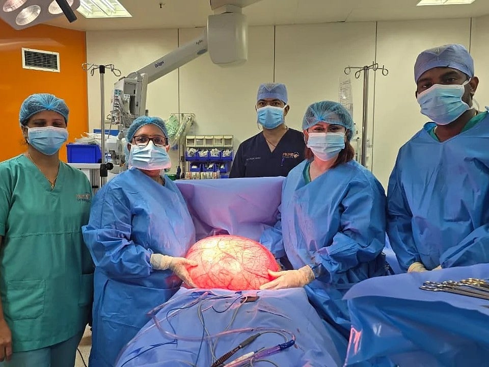 The medical team with the massive cyst.