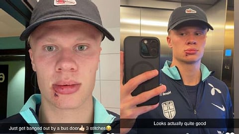 Manchester City striker Erling Haaland cleared to play after freak accident leaves him with cut on face