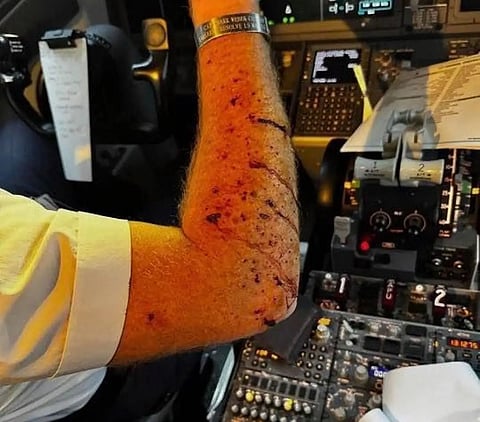 The Boeing 737 Max 8 carrying 140 passengers and crew, was diverted for an emergency landing after the aircraft experienced a cracked cockpit windshield, resulting in bruises for the pilot. 