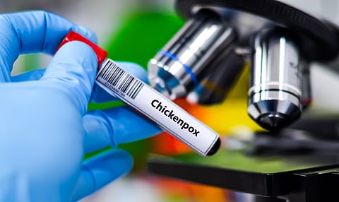 Chickenpox, caused by the varicella-zoster virus, is highly contagious and spreads through coughing, sneezing, or direct contact with an infected person.